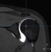 artro hombro 1 Resonancia Magnética