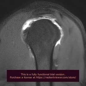 hombro sag artro00001 1 Resonancia Magnética