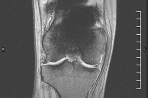 artefacto ferromagnético por prótesis de rodilla