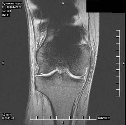 artefacto ferromagnético por prótesis de rodilla