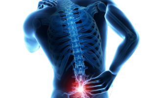 lumbar ciatica