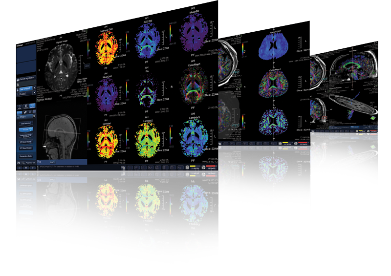 Resonancia magnética de cerebro