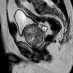 Resonancia Magnética de Próstata