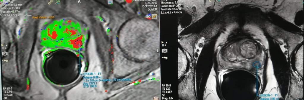 Resonancia magnética multiparamétrica de próstata