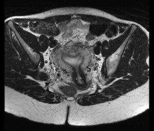 Resonancia magnética de la pelvis
