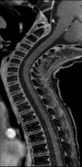 cervical 1 El Mundo Resonancia Magnética