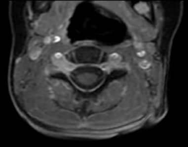 resonancia magnética de columna cervical 