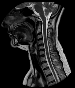 resonancia magnética cervical