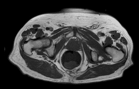 Resonancia Magnética de caderas