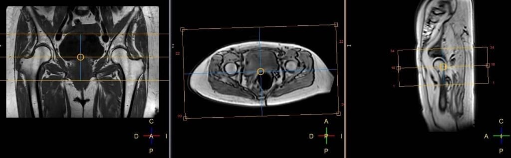 Resonancia Magnética de caderas