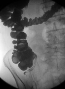 Enema Opaco