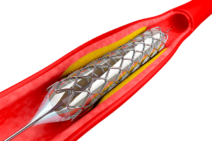 angioplastia