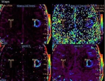 mapas de perfusión