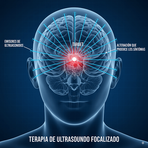 HIFU (Ultrasonido Focalizado de Alta Intensidad)