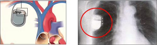 Marcapasos y resonancia magnética: lo que necesitas saber 6 Marcapasos