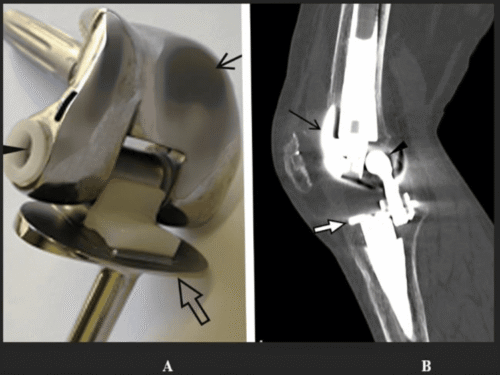 🧲 Prótesis y resonancia magnética: todo lo que debes saber antes de entrar al imán 4 Protesis de rodilla