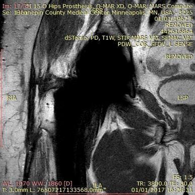 🧲 Prótesis y resonancia magnética: todo lo que debes saber antes de entrar al imán 5 artefacto ferromagnético por prótesis de cadera