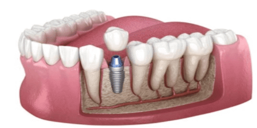 🧲 Prótesis y resonancia magnética: todo lo que debes saber antes de entrar al imán 2 implante dental